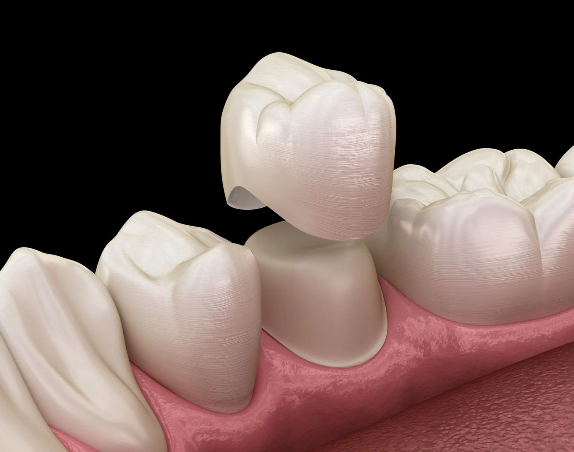 Capsula in Ceramica1