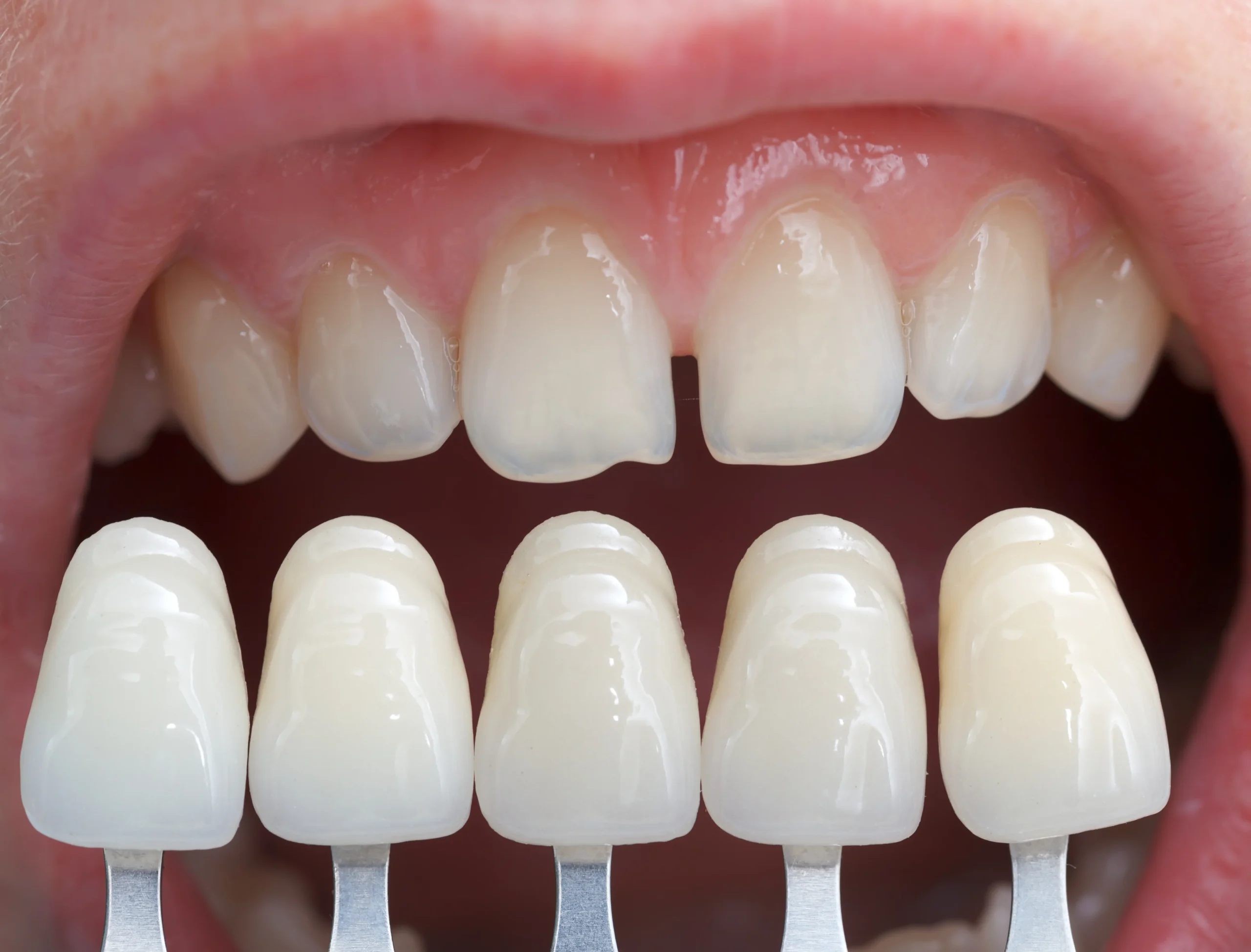 Denti Al Zirconio