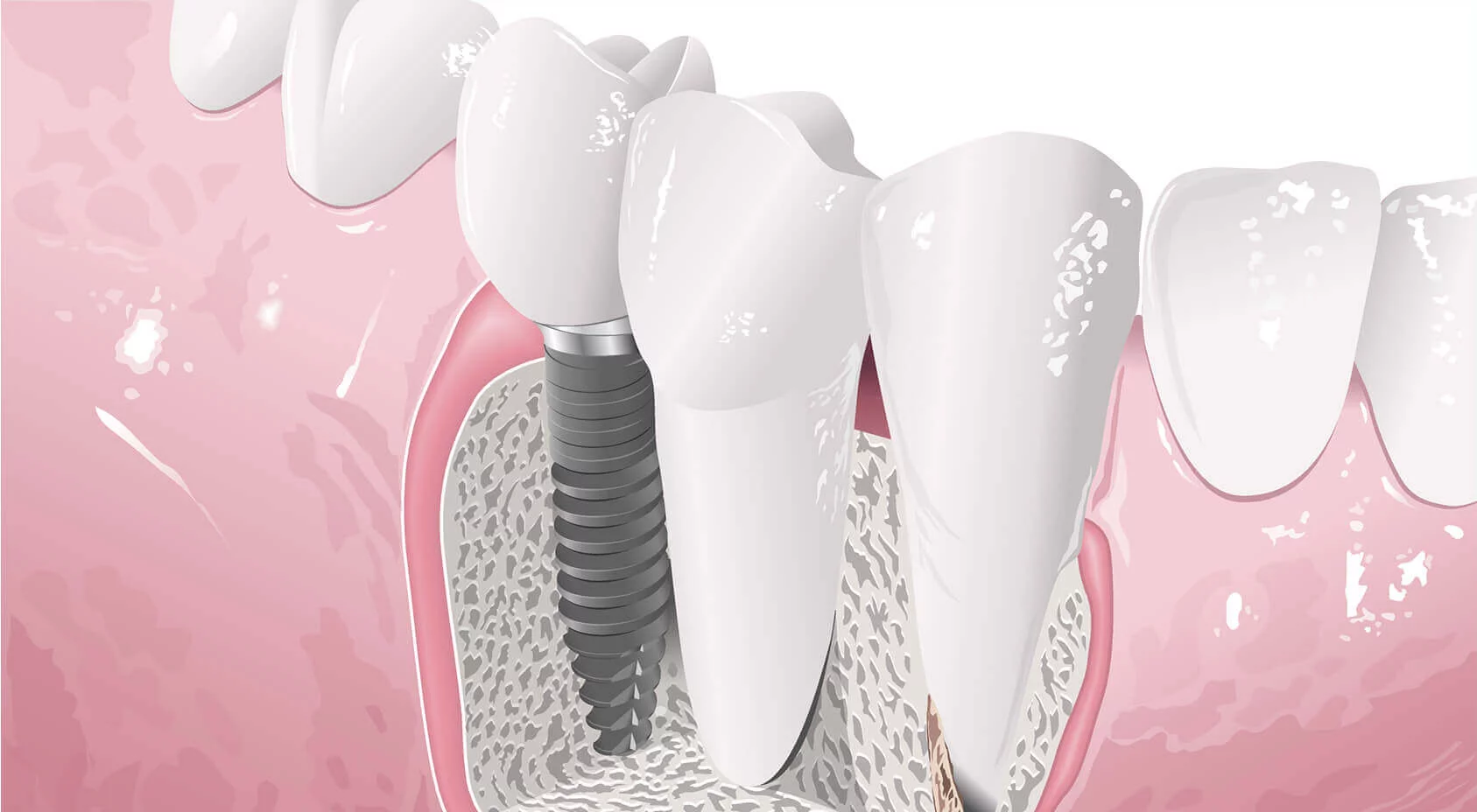 Prezzi Dei Denti In Zirconio
