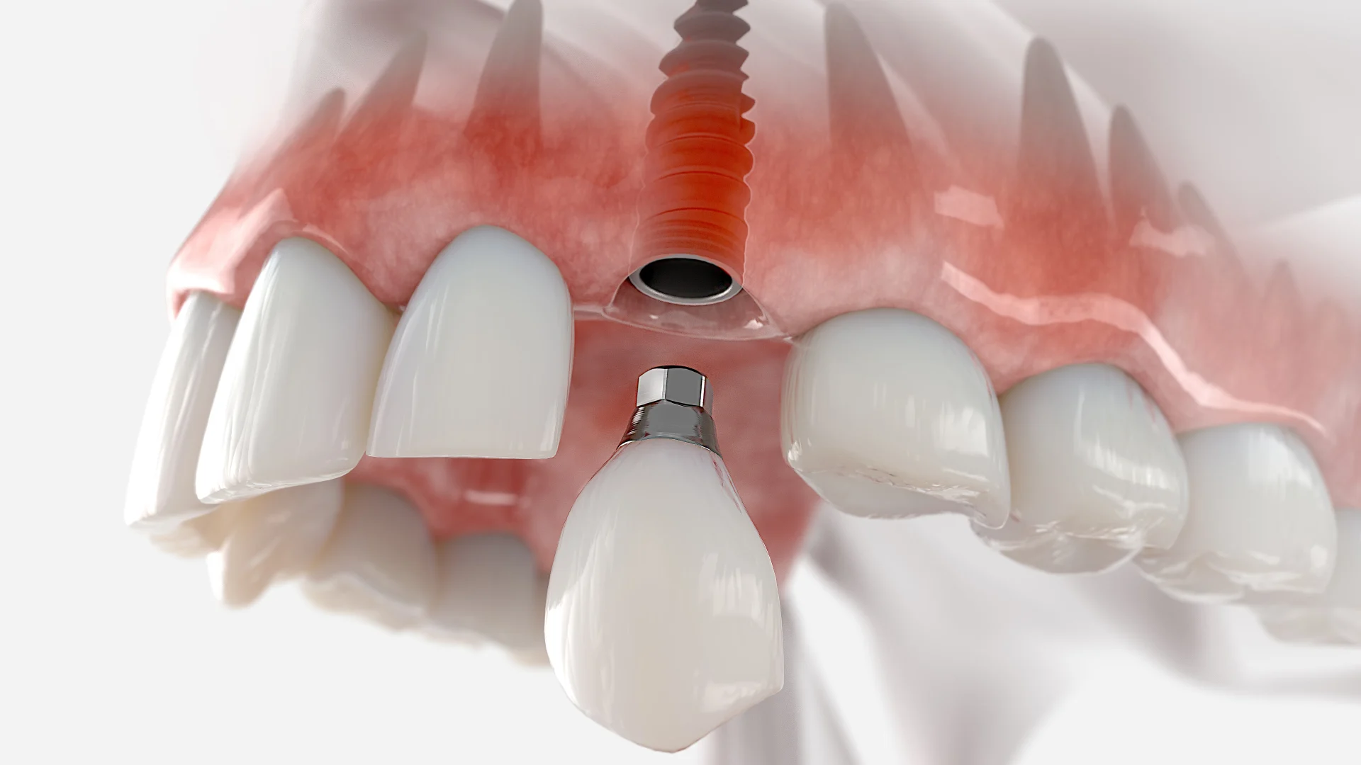 Immediate load dental implants