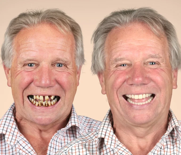 Risultato All on 4 - Clinica Dentale Albania