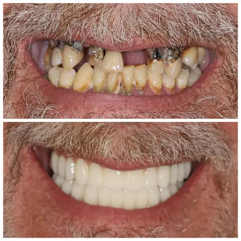 Prima e Dopo Implantologia - Clinica Dentale Albania
