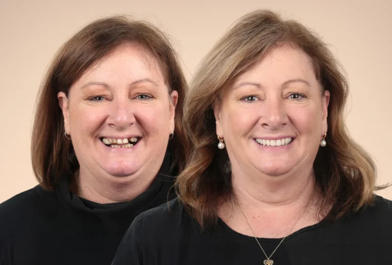 Sorriso Trasformato con Faccette - Clinica Dentale Albania
