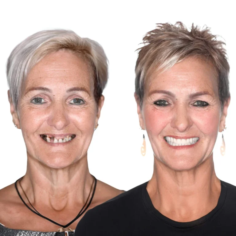 Impianti Dentali Prima Dopo - Clinica Dentale Albania