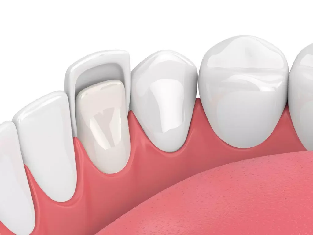 Faccette dentali - illustrazione