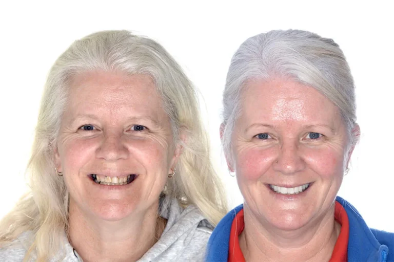 Riabilitazione Orale Completa - Clinica Dentale Albania