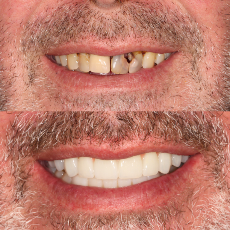 Prima e Dopo All on Four - Clinica Dentale Albania