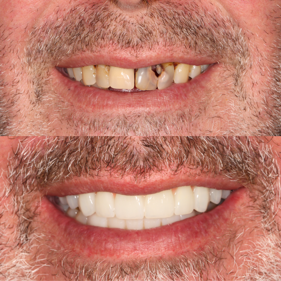 Prima e Dopo All on Four - Clinica Dentale Albania