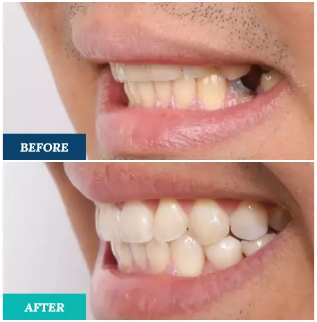 Trasformazione Sorriso Completa - Clinica Dentale Albania