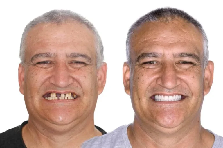 Trasformazione Sorriso con Impianti - Clinica Dentale Albania