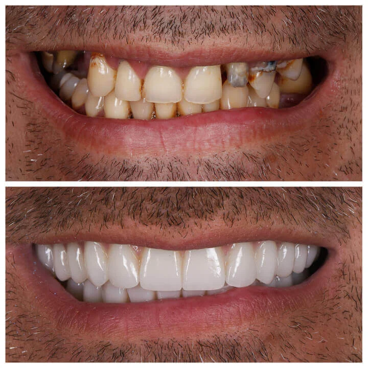 Impianti Dentali Accessibili - Clinica Dentale Albania
