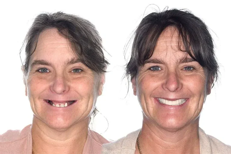 All on 4 Prima e Dopo - Clinica Dentale Albania Tirana