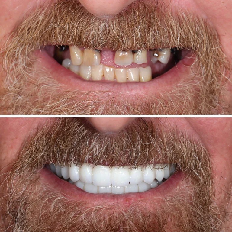All on 4 Paziente Soddisfatto - Clinica Dentale Albania