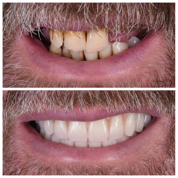 All on 4 Arcata Completa - Clinica Dentale Albania
