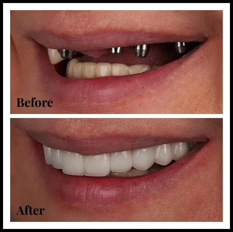All on 4 Risultato Eccellente - Clinica Dentale Albania