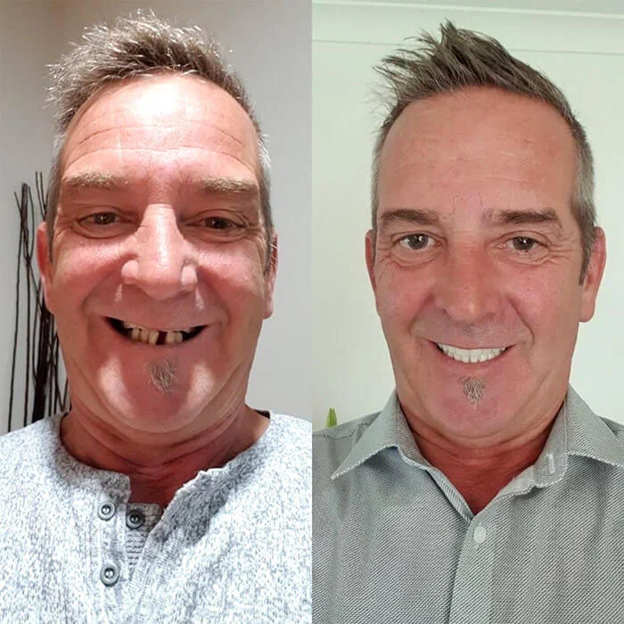 Prima e Dopo Sorriso - Clinica Dentale Albania