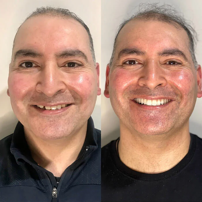 Impianto Dentale Risultato - Clinica Dentale Albania