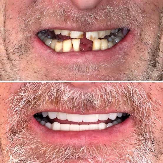 Risultato Corone Dentali - Clinica Dentale Albania