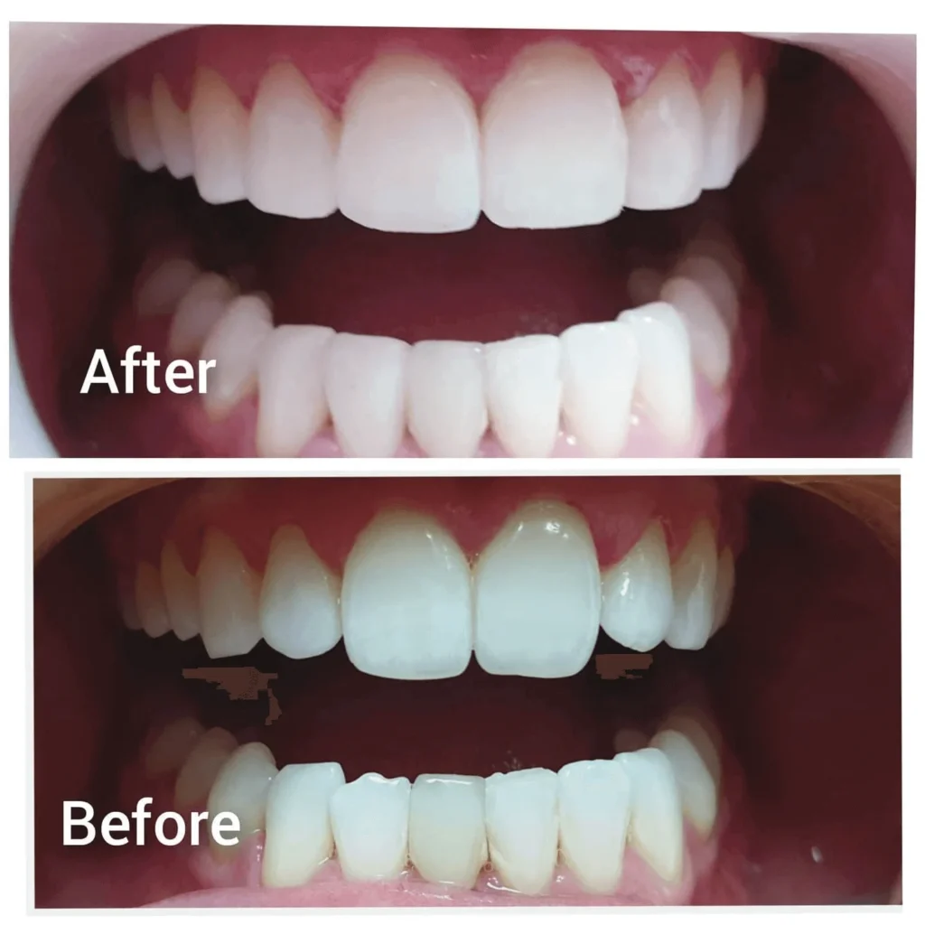 Bonded Teeth
