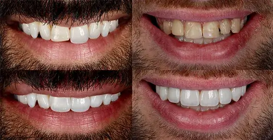 Bonded Teeth