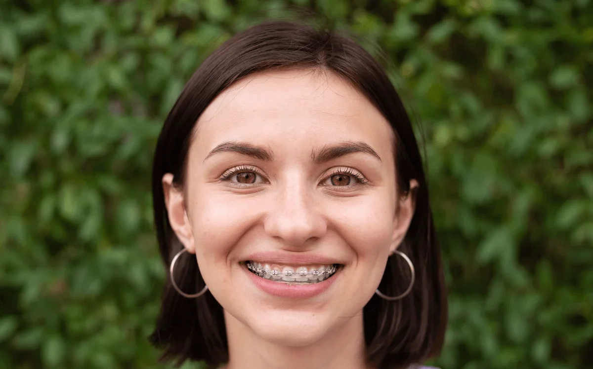 Braces On Adults