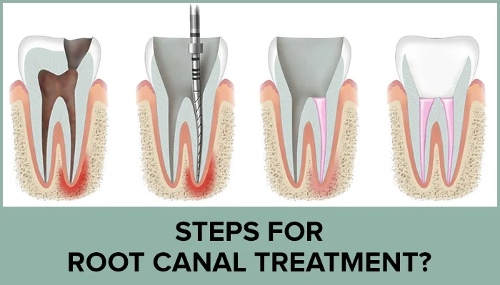 CANAL ROOT TREATMENT