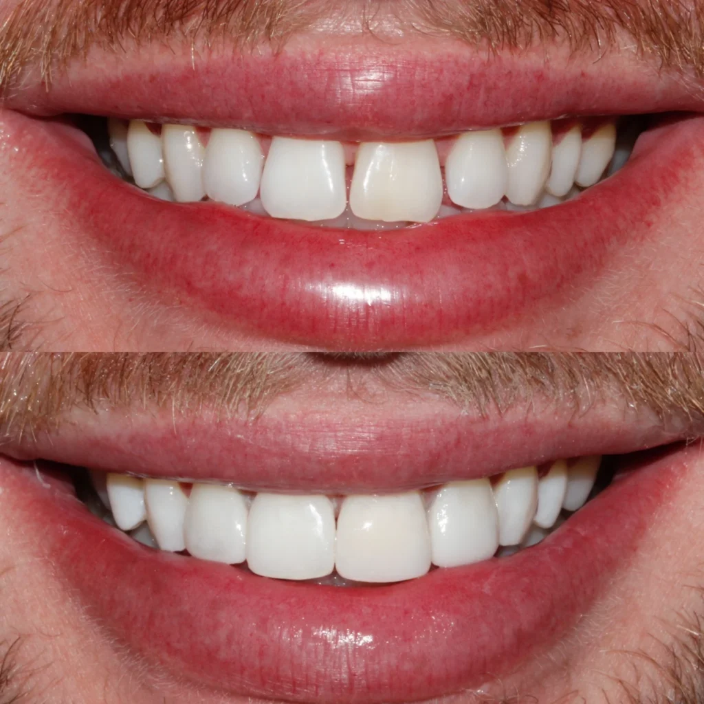 Composite Dental Bonding