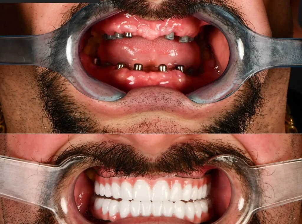 Cost Of Dental Implants In Turkey