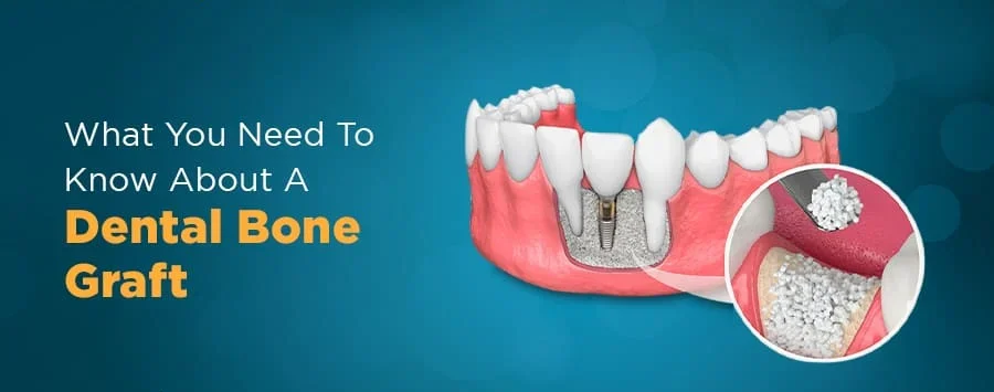 DENTAL BONE GRAFT COST