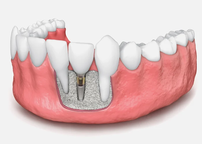 DENTAL BONE GRAFT SPECIALIST