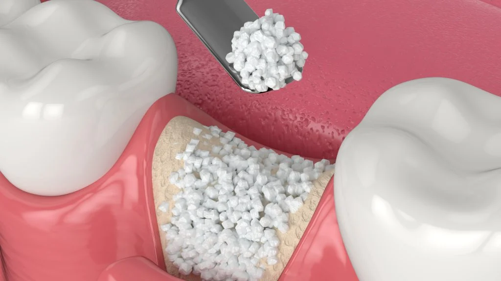 DENTAL BONE GRAFT SPECIALIST