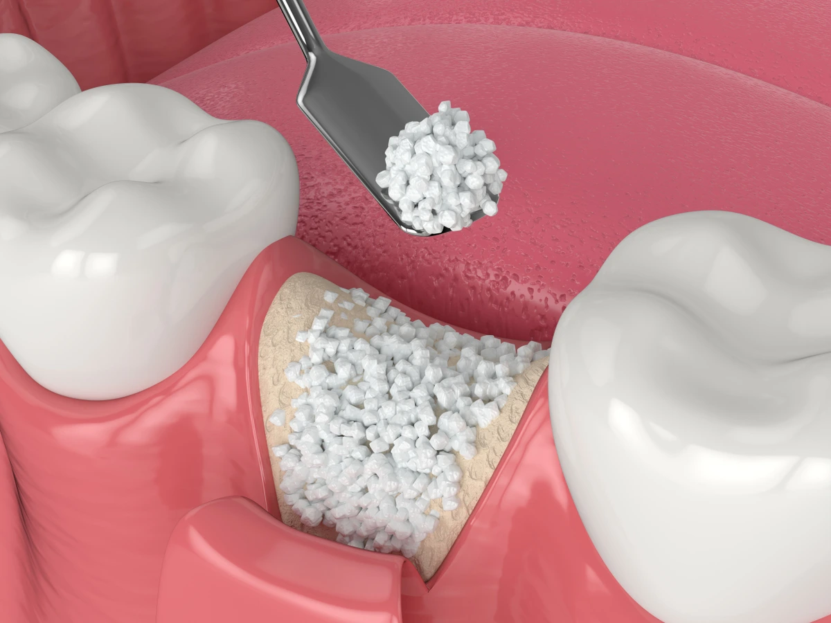 Dental Bone Graft Cost