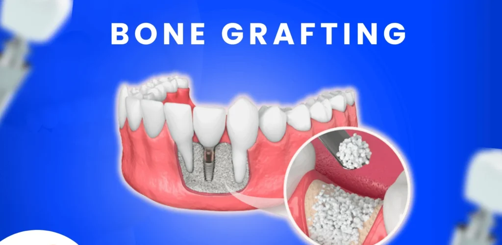 Dental Bone Graft Cost