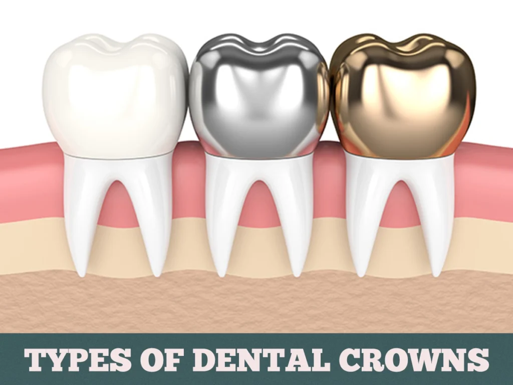 Dental Crown Cost