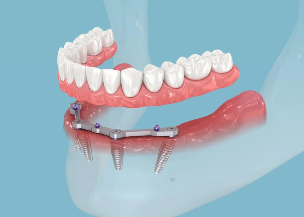 Dental Implants All On Four