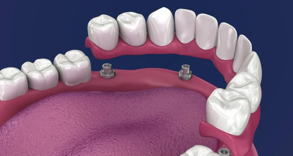 Dental Implants On The NHS