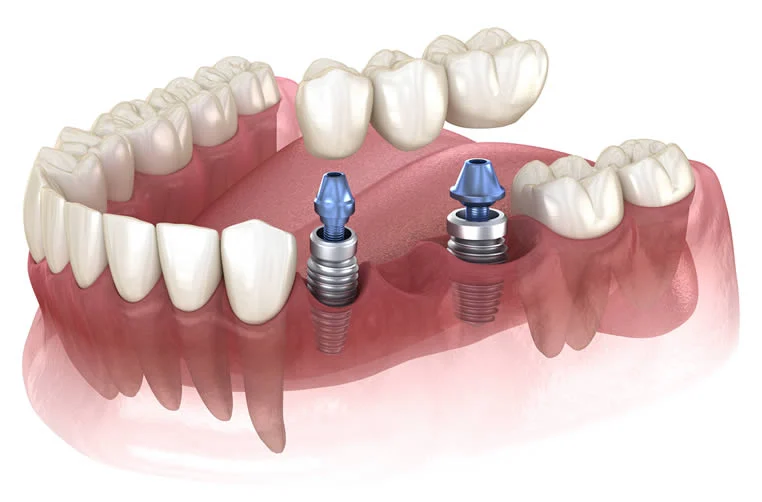 Dental Implants UK