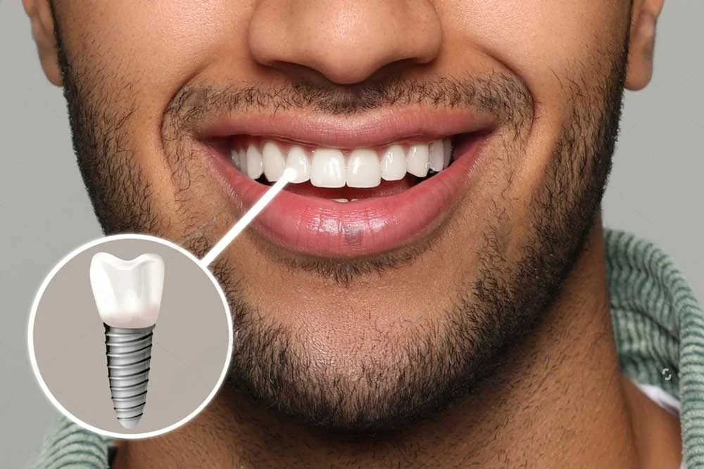 Dental Implants UK Cost