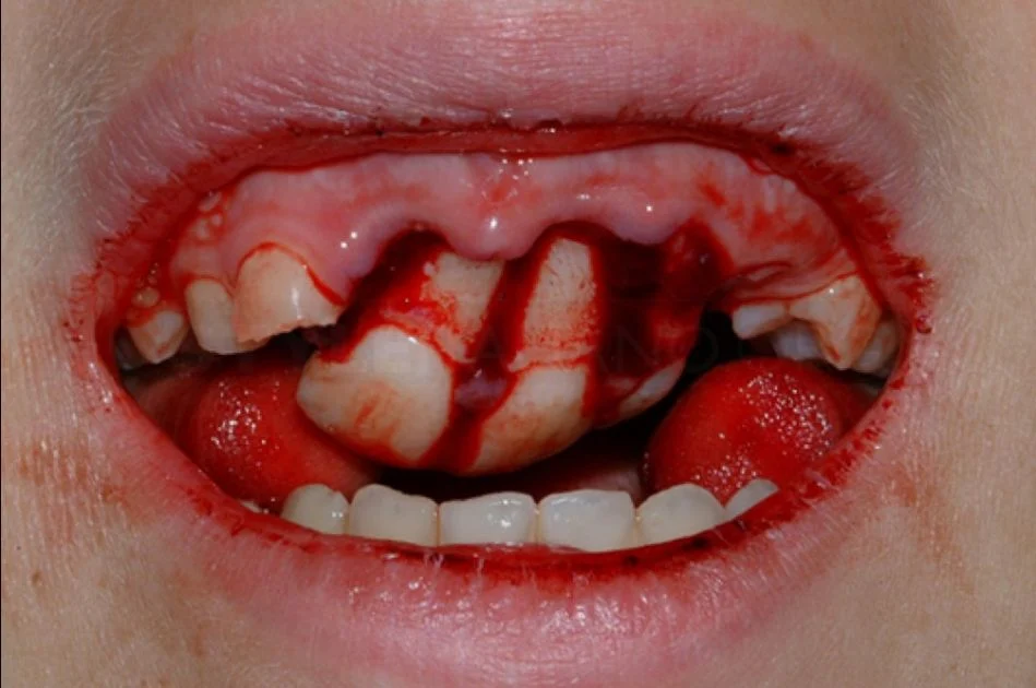 Dental Trauma