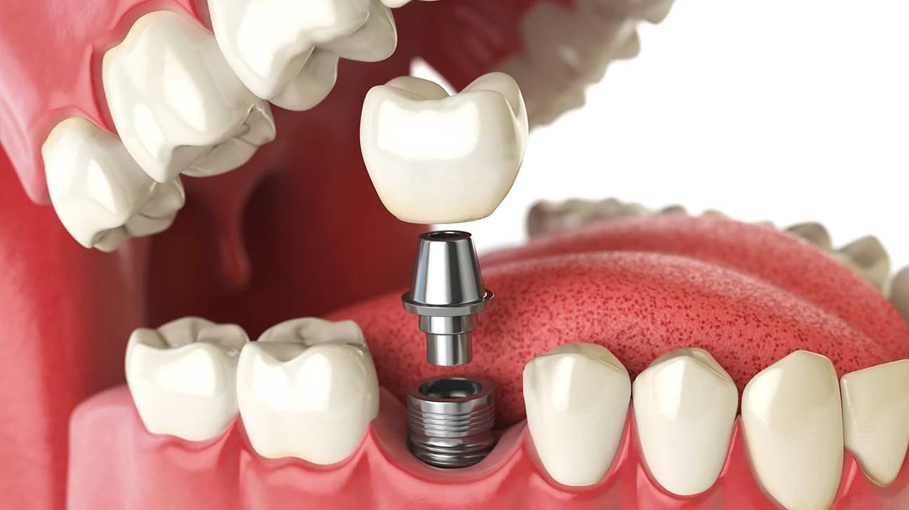FALSE TOOTH