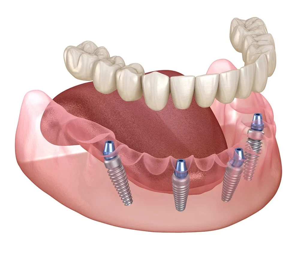 Full Mouth Dental Implants