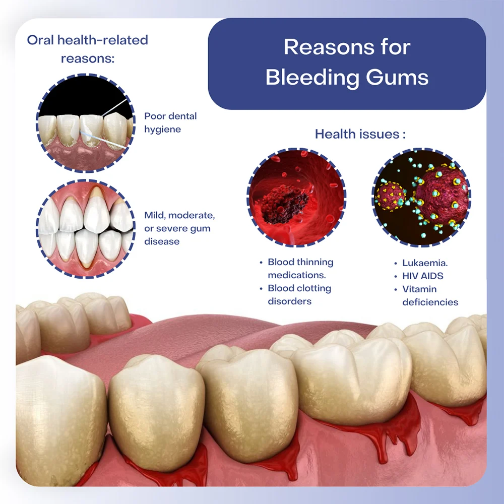 Gum Bleeding