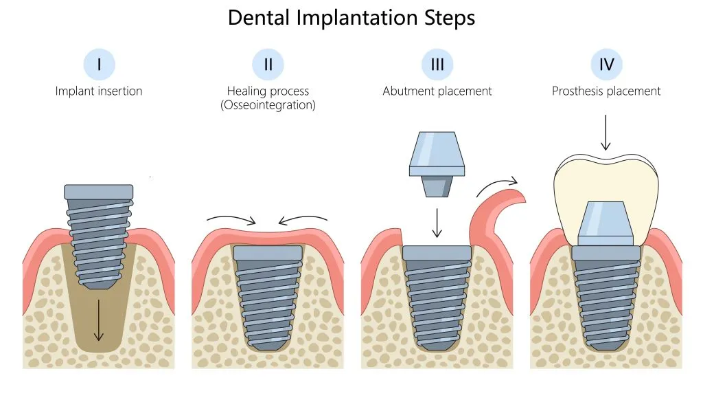 Implant Procedure