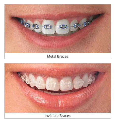 Invisible Dental Braces