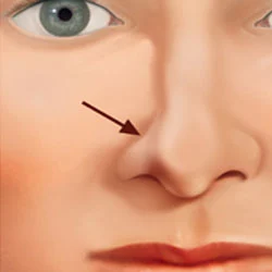 Nostril Collapse
