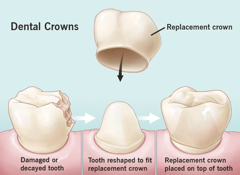 Porcelain Caps Dental Crowns