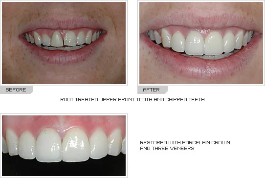 Porcelain Caps Dental Crowns