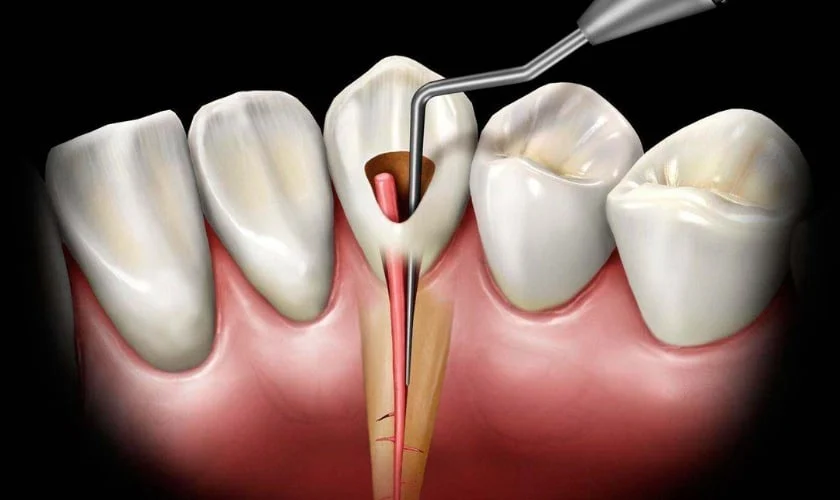 Root Canal And Pain After
