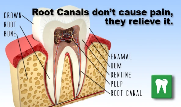 Root Canal And Pain After