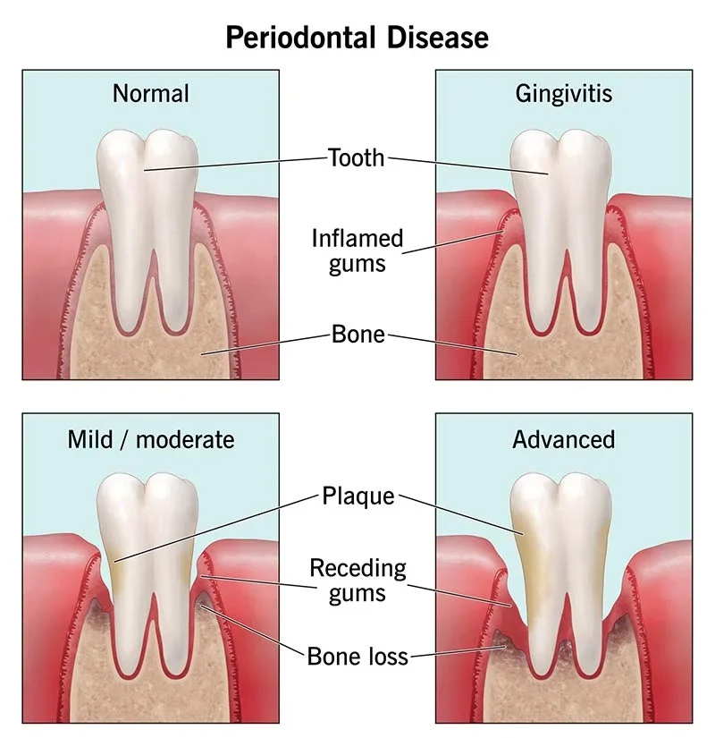 Sign Of Gum Disease